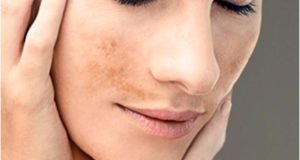 Cómo prevenir las manchas de la cara